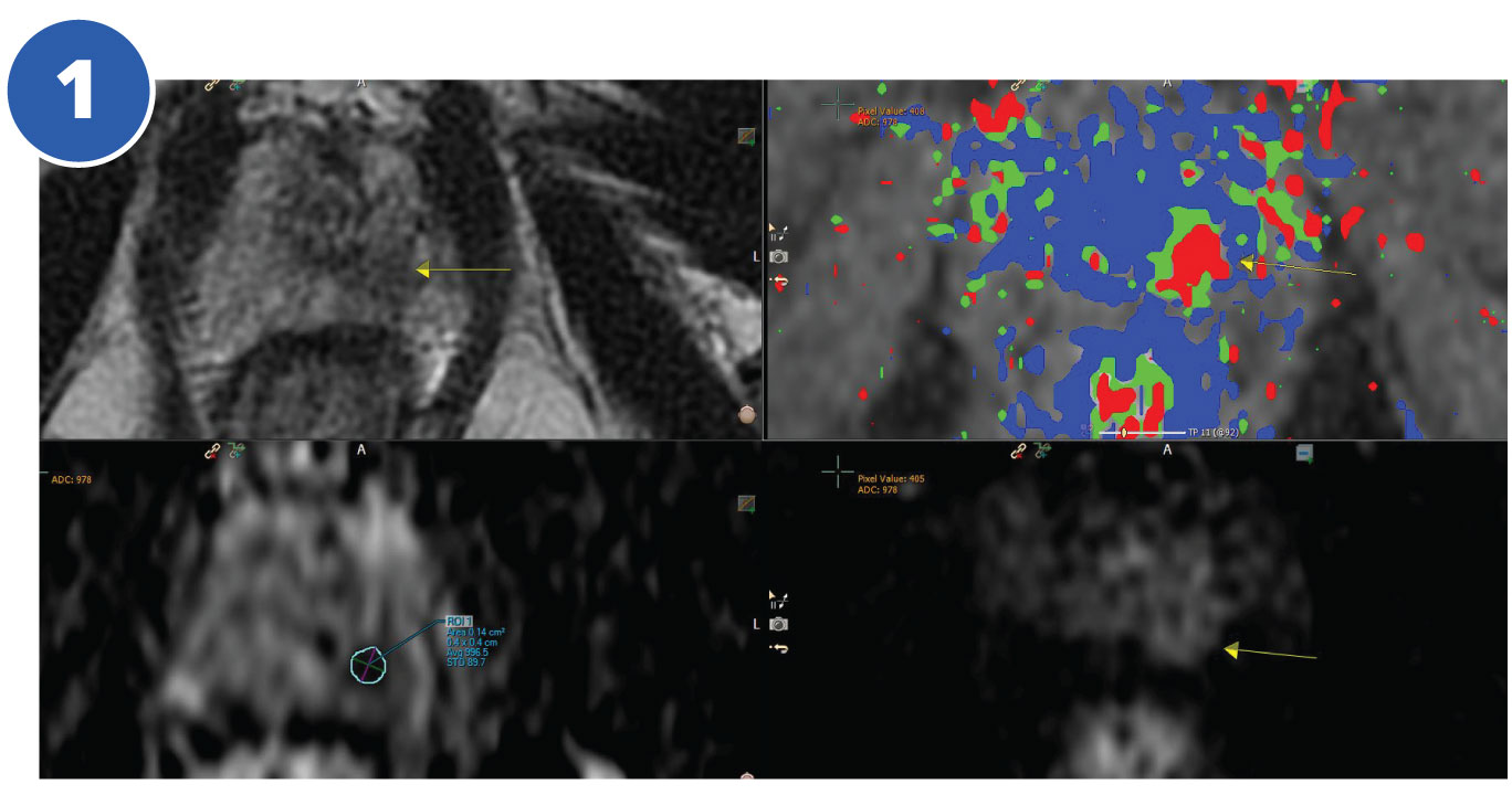 Prostate Tulsa Procedure Case Study