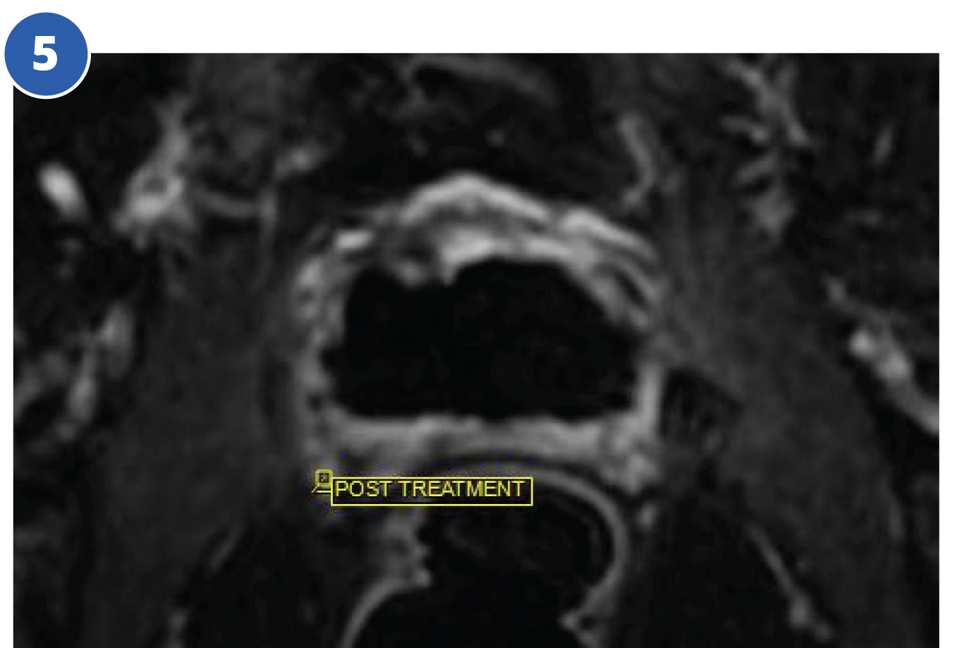 Prostate Tulsa Procedure Case Study